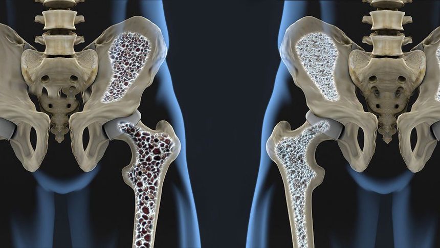 De ce este important să participi la webinarul Stop Osteoporoză